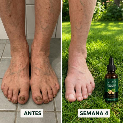 NO ESCONDAS EL HONGO, ELIMÍNALO: PENETRACIÓN PROFUNDA PARA ELIMINARLO DE RAÍZ