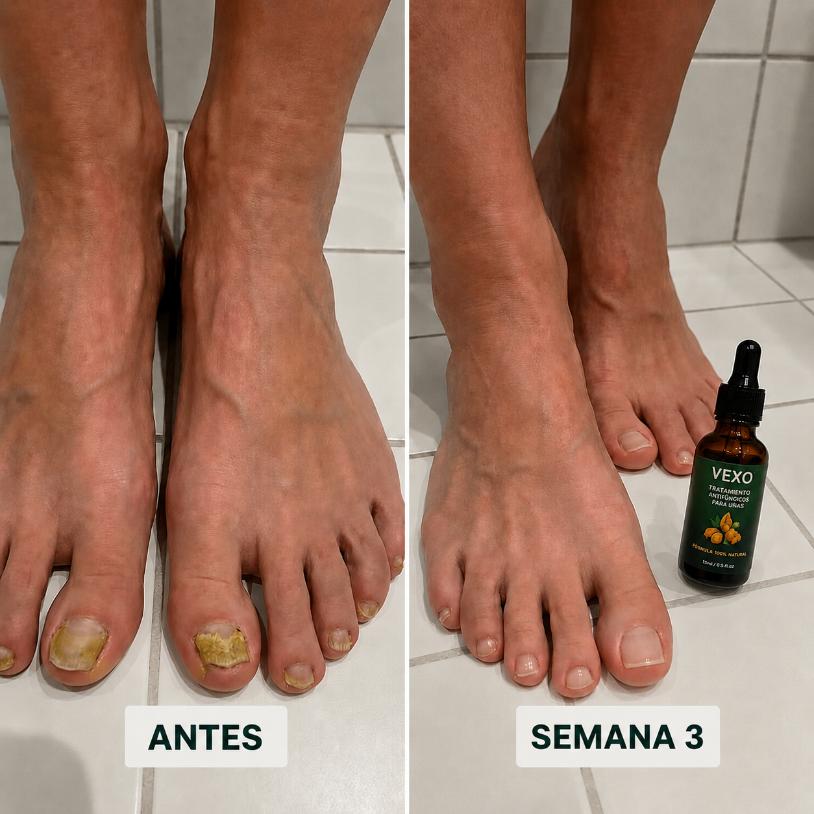 NO ESCONDAS EL HONGO, ELIMÍNALO: PENETRACIÓN PROFUNDA PARA ELIMINARLO DE RAÍZ